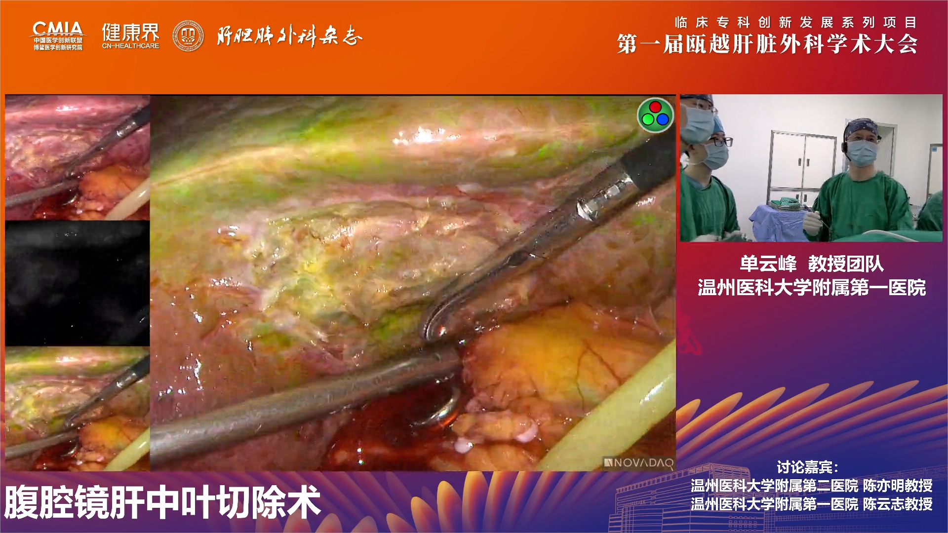 单云峰主任团队手术直播.png
